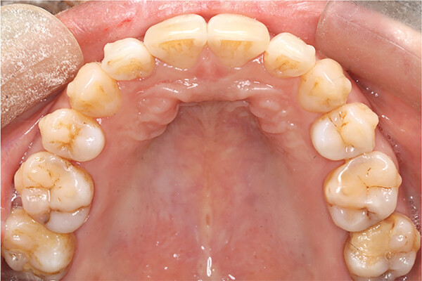 Lateral Incisor Extraction